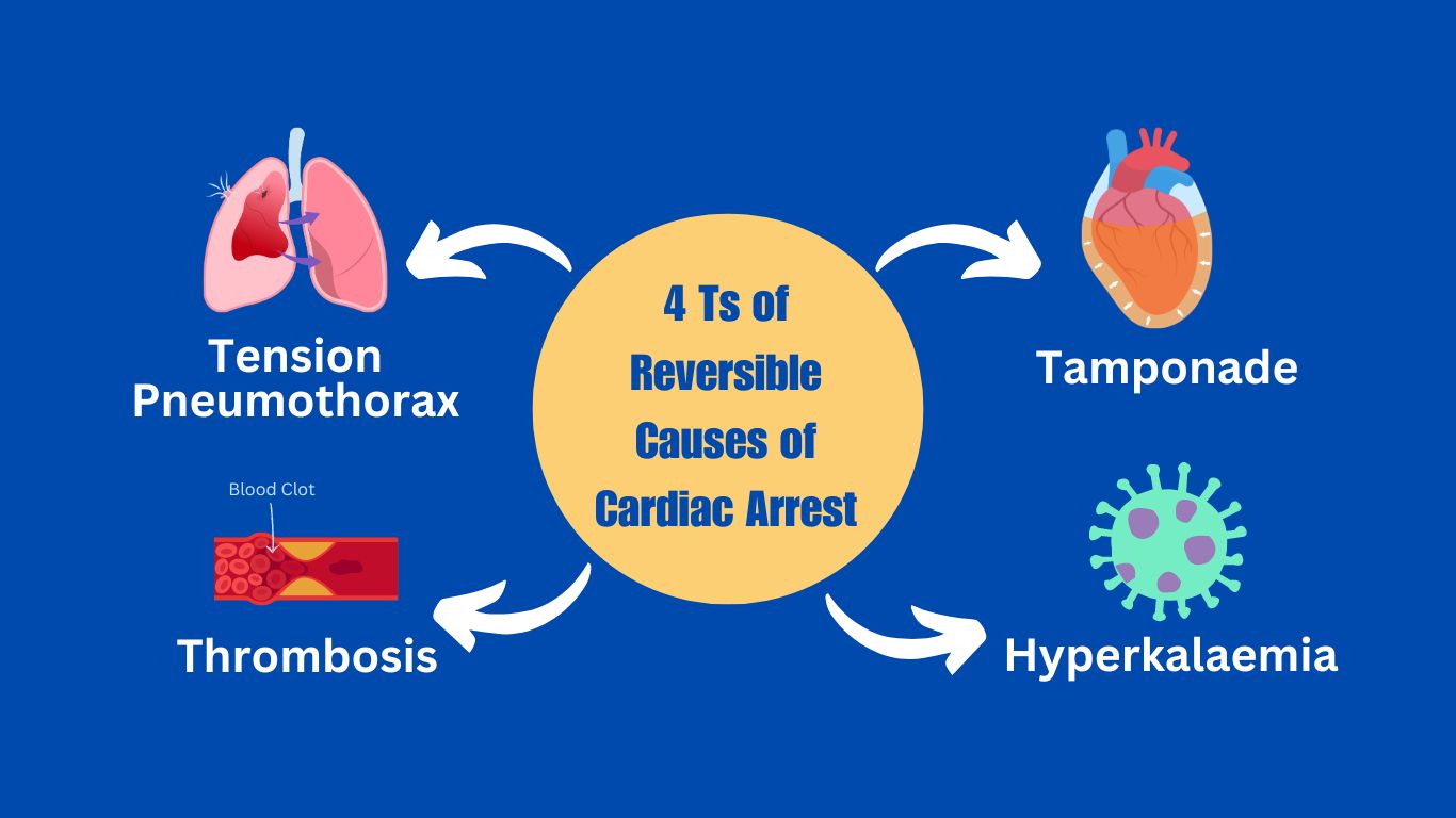 4 Ts of Reversible Causes of Cardiac Arrest
